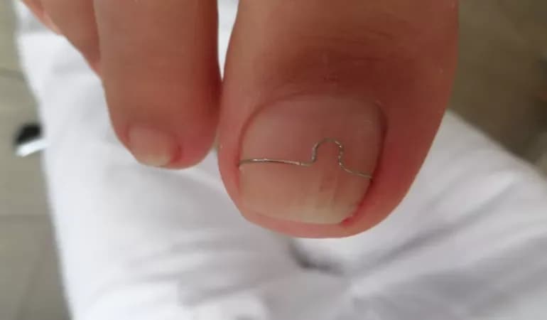 Dlaczego paznokcie u nóg rosną do góry? Poznaj przyczyny i rozwiązania